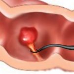 polipin çıkarılması